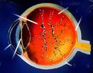 Triệu chứng bệnh xuất huyết dịch kính sau chấn thương mắt